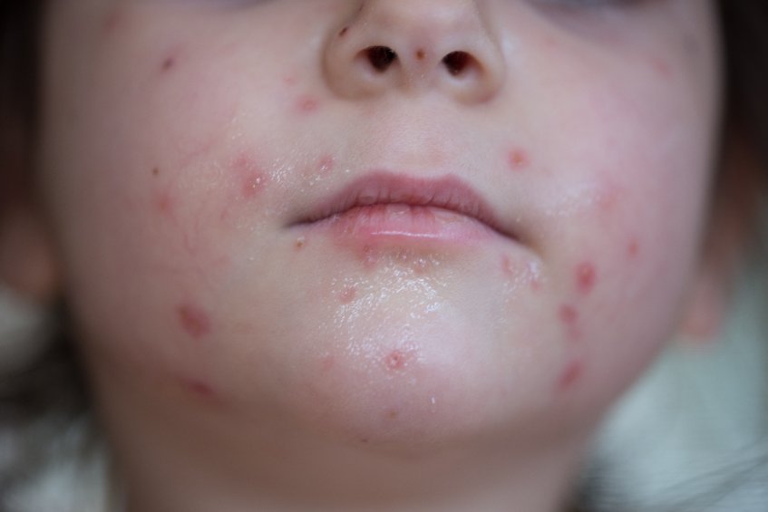 Diagnostic de l'herpès circiné par examen dermatologique et lumière de Wood