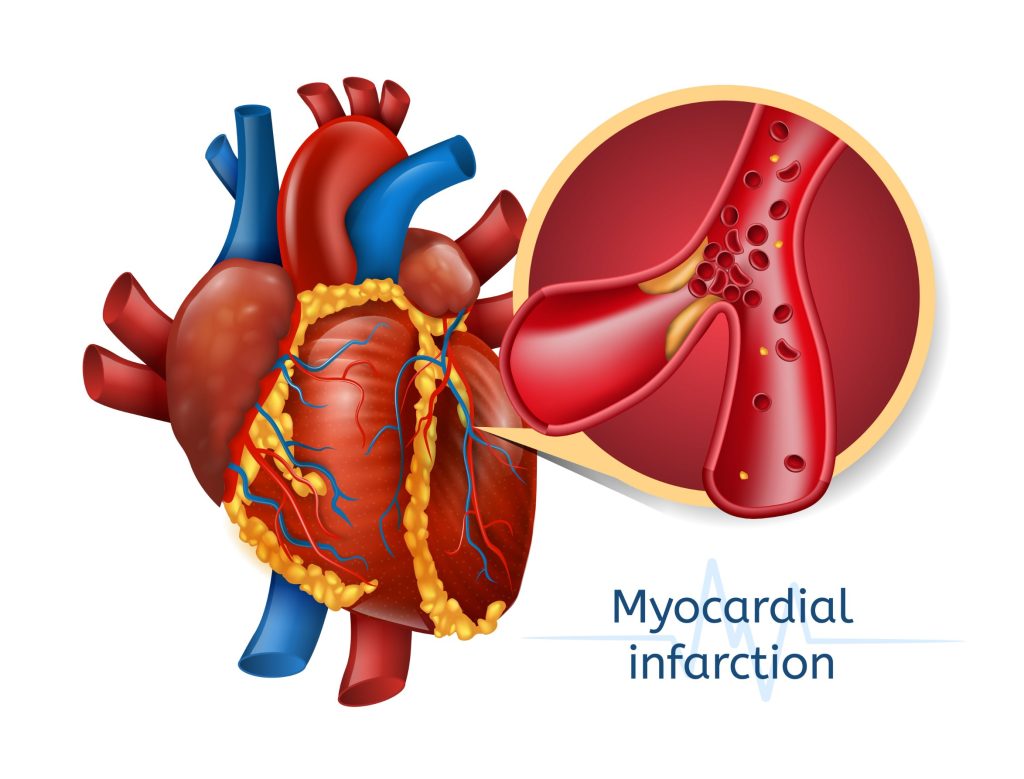 Infarctus du myocarde : Causes, Symptômes et Traitements