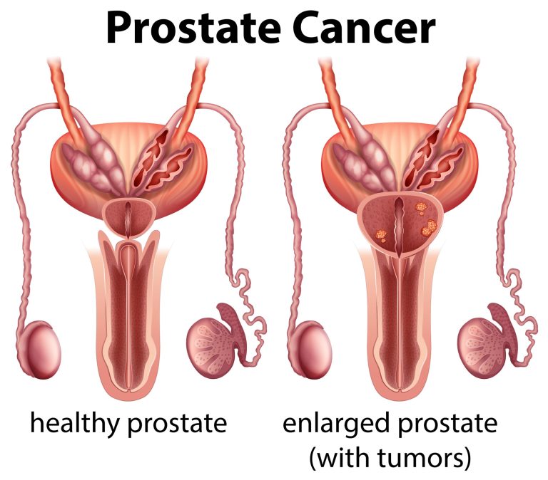 LE DÉPISTAGE INDIVIDUEL DU CANCER DE LA PROSTATE : 30 QUESTIONS-RÉPONSES