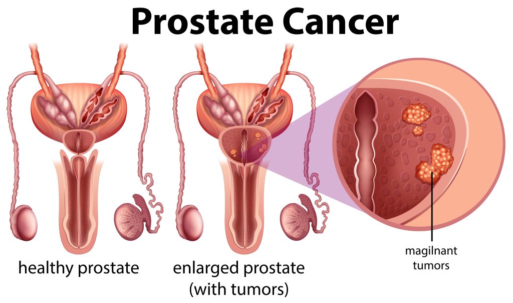 Cancer de la prostate : stades d’évolution, causes et traitements