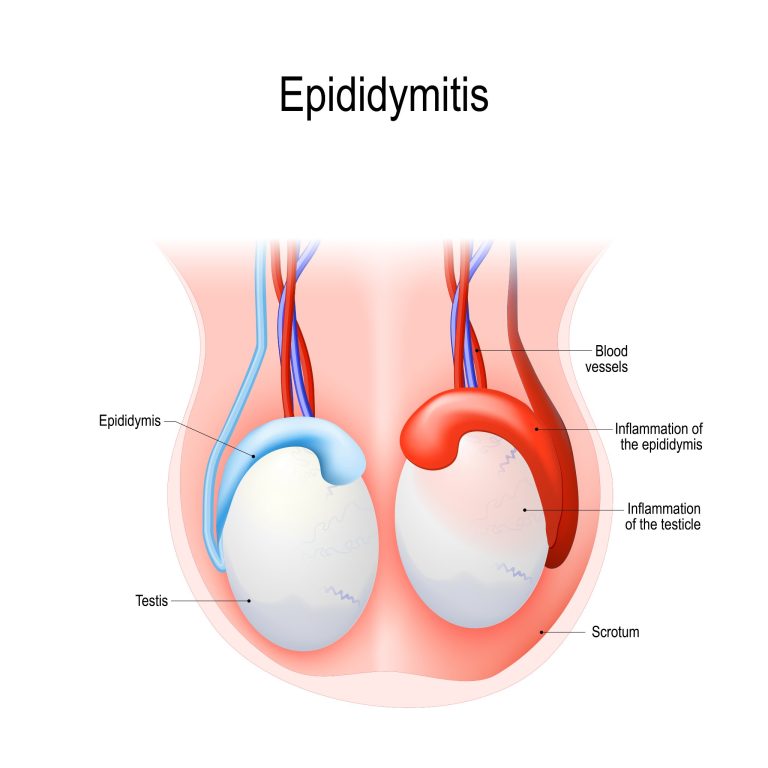 Épididymites ou orchi-épididymites : causes, symptômes et traitements