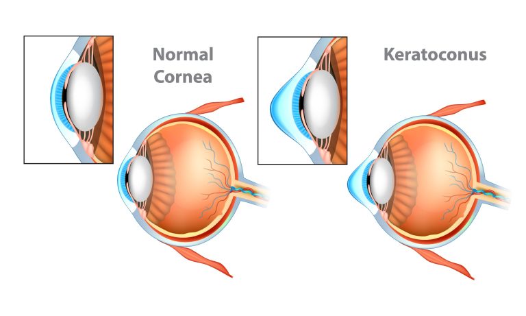 Kératocône :causes, symptômes et traitements