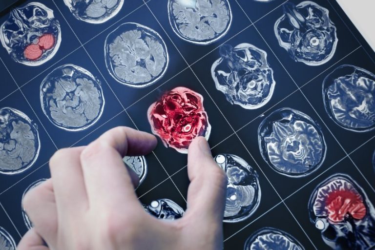 Maladie d’Alzheimer (ALZ) et troubles apparentés : définition, causes, symptômes, diagnostic et traitements
