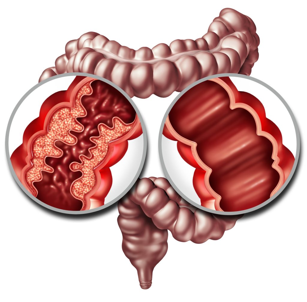 Traitement médical de la maladie de Crohn 115452241 M 1024x1007