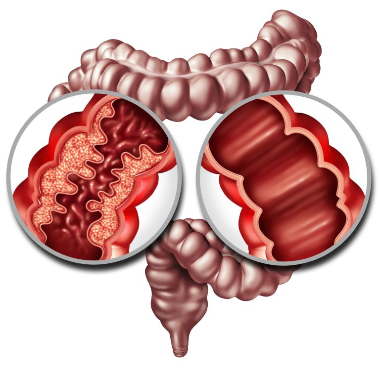 Traitement médical de la maladie de Crohn