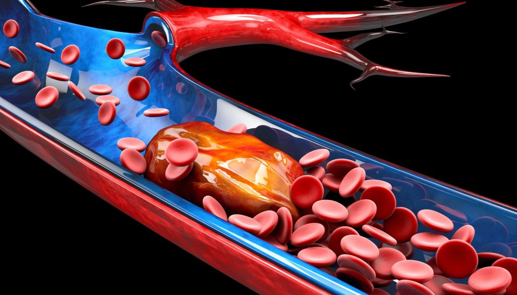Thrombose veineuse: facteurs de risque, symptômes et traitements