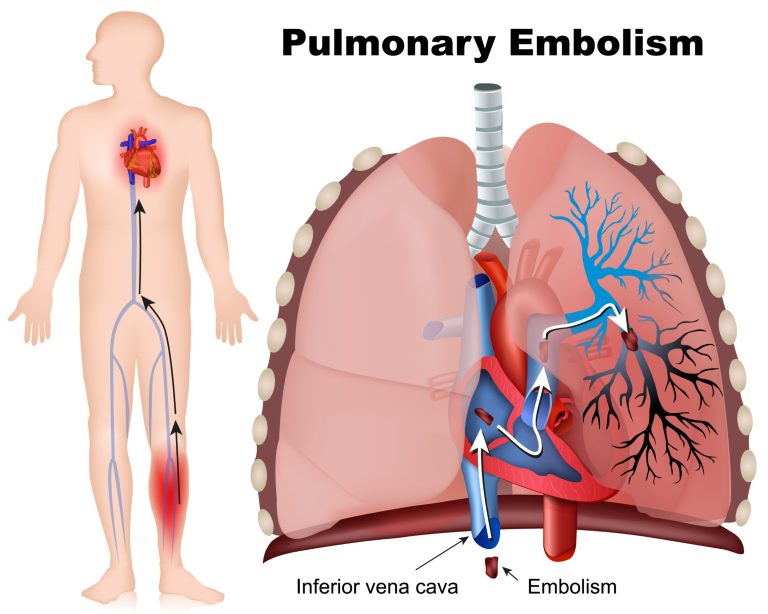 Embolie pulmonaire : causes, symptômes et traitements
