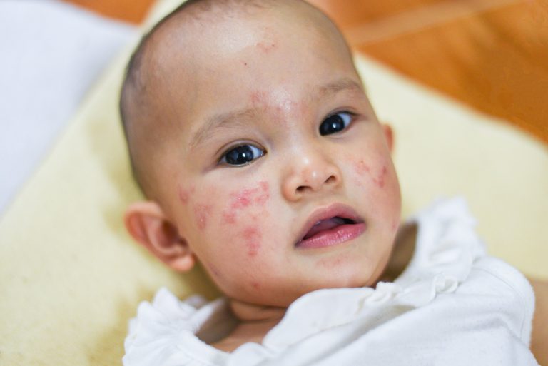 Éruptions cutanées d&rsquo;origine virale de l’enfant : causes et traitements