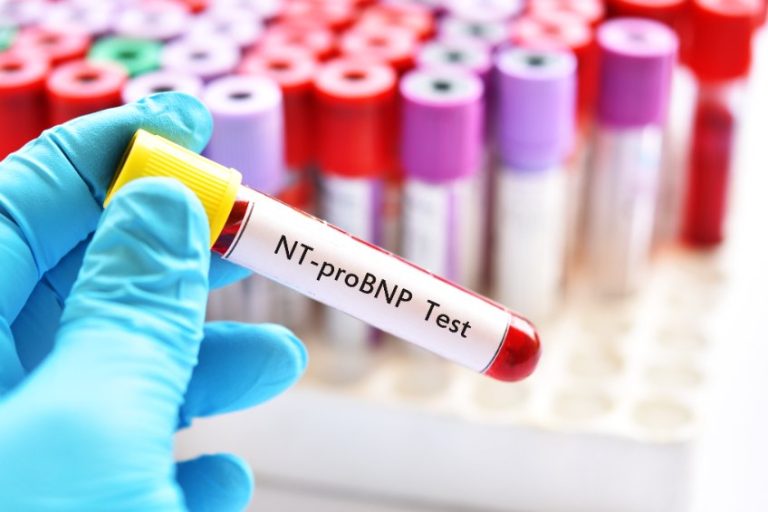 NT-proBNP : intérêt en biologie clinique 