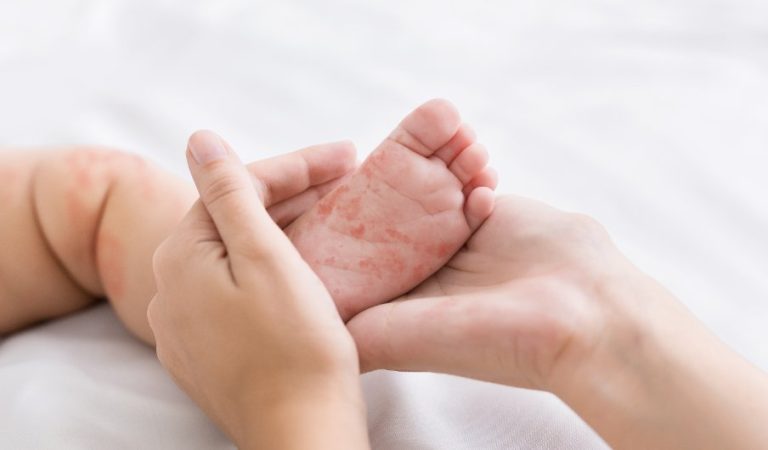 Amoxicilline et éruption cutanée chez l’enfant : Causes, Symptômes, Diagnostic, Traitement, Alternatives 