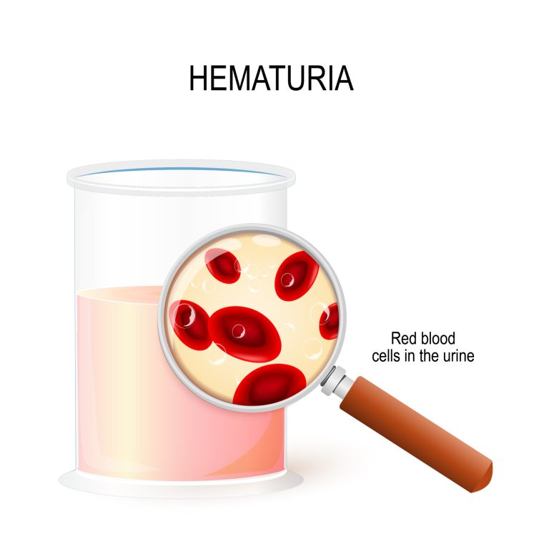 Hématurie : causes, symptômes et traitements