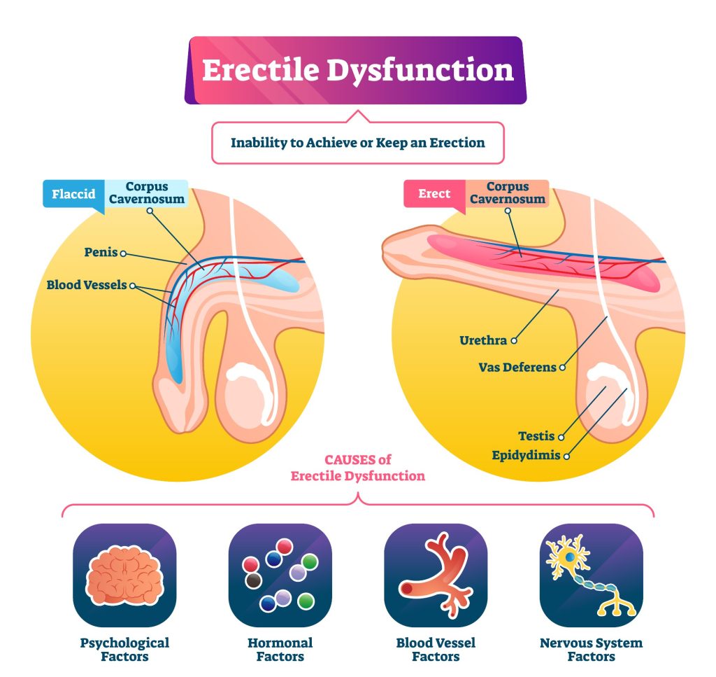 Dysfonctionnement érectile et impuissance : causes et traitements