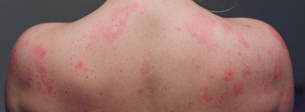 Syndrome de Gianotti-Crosti : causes, symptômes, traitement