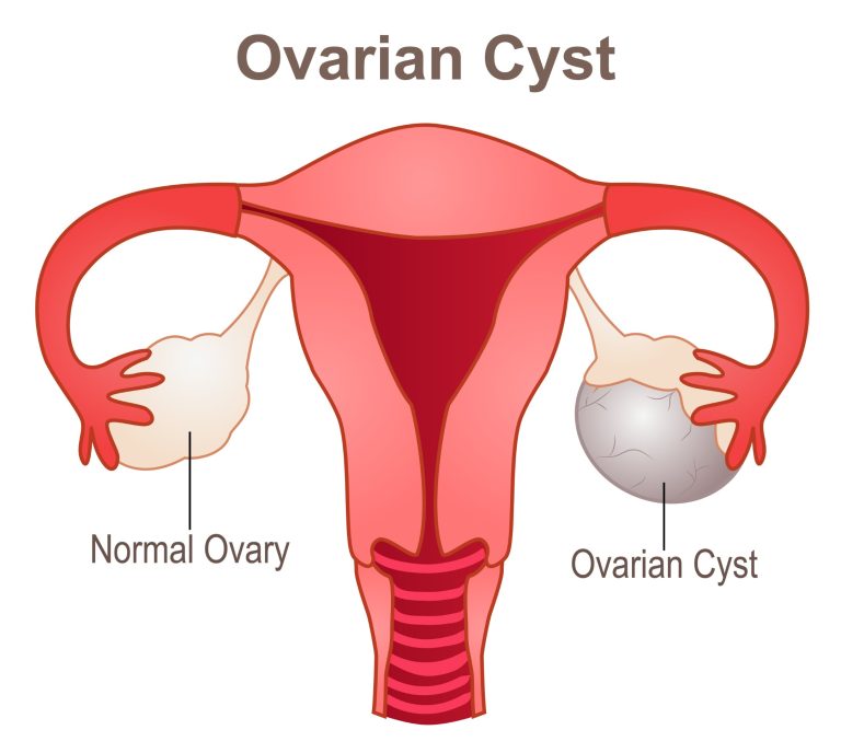 KYSTE DE L’OVAIRE EN PÉRI ET POST-MENOPAUSE : symptômes et traitements