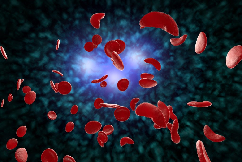 Drépanocytose : causes, symptômes et traitements