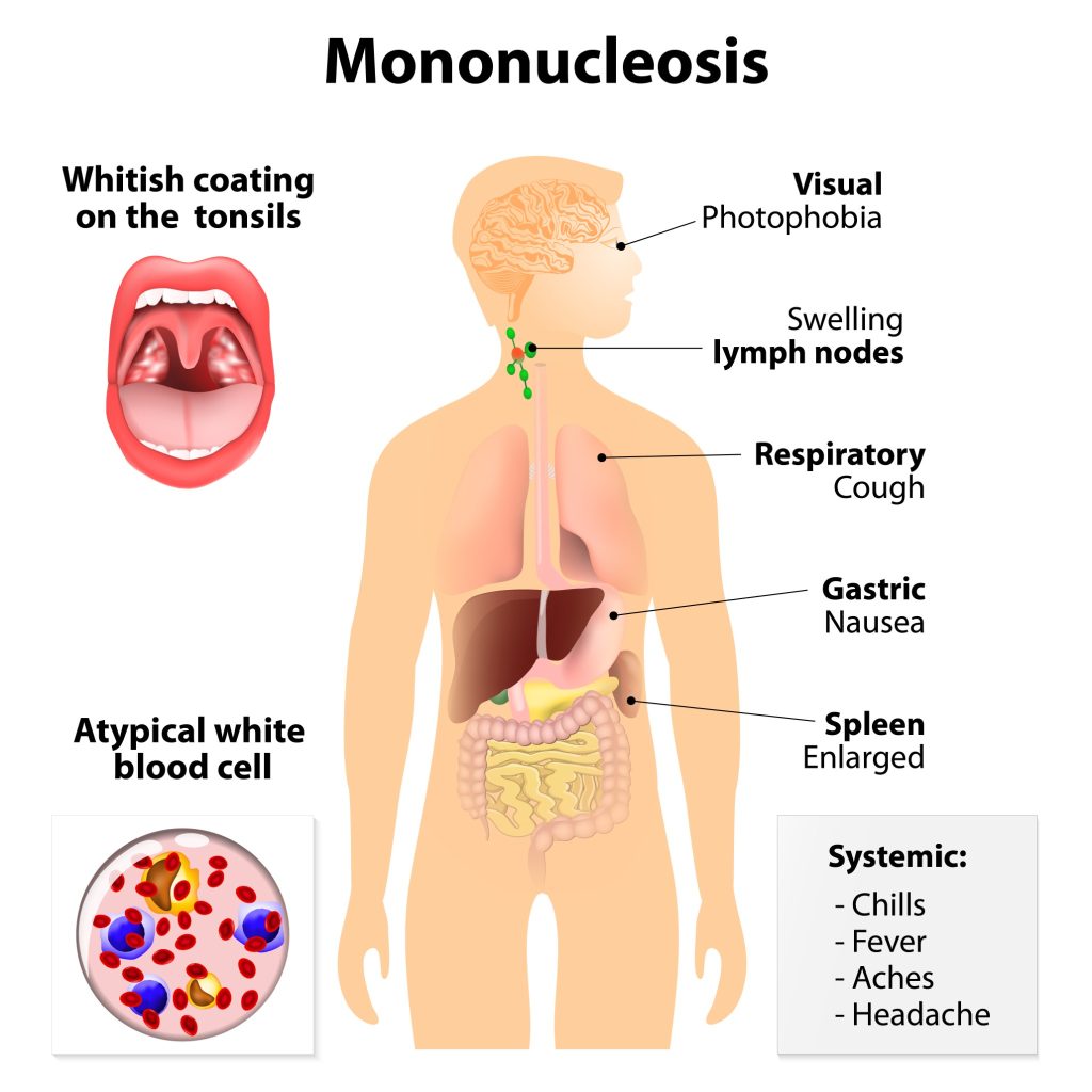 SYNDROME MONONUCLEOSIQUE : symptômes et traitements