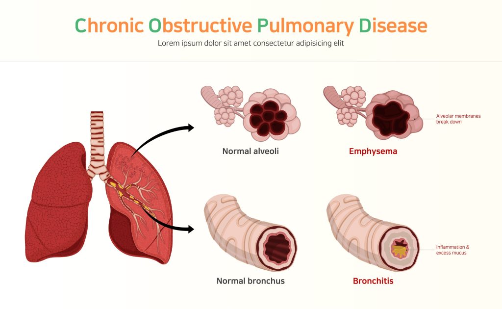 BPCO : causes, symptômes et traitements