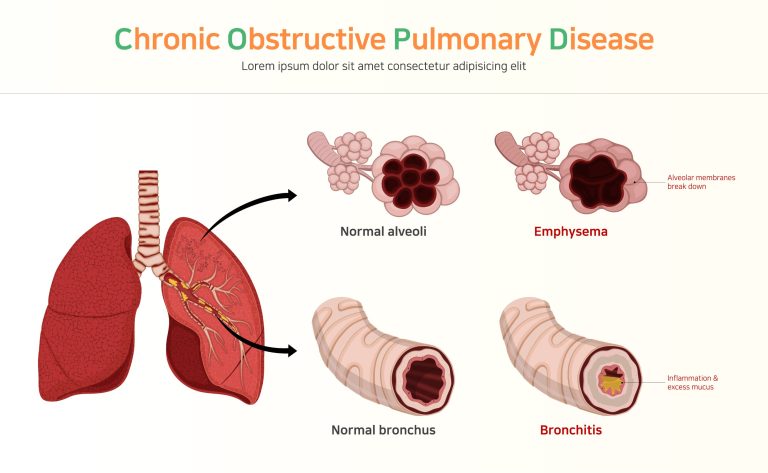 BPCO : causes, symptômes et traitements