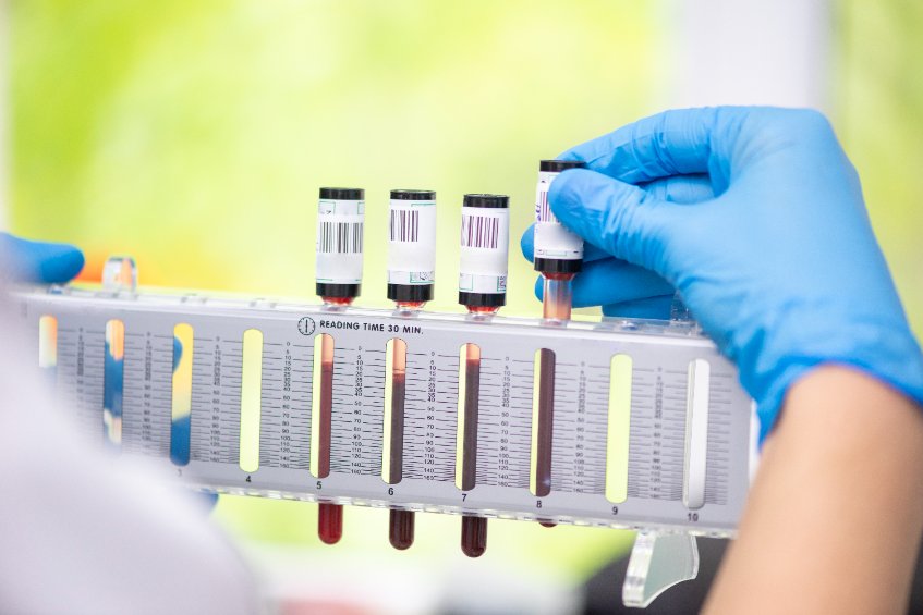 Augmentation de la vitesse de sédimentation : causes, conduite à tenir