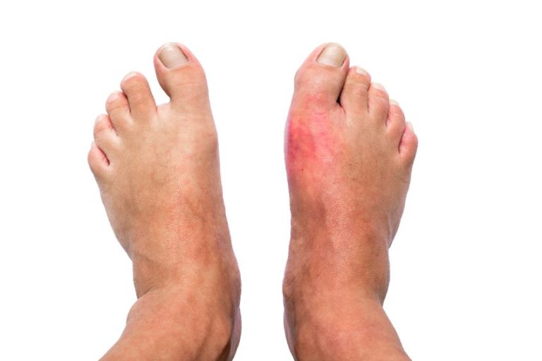La goutte : causes, diagnostic et traitements