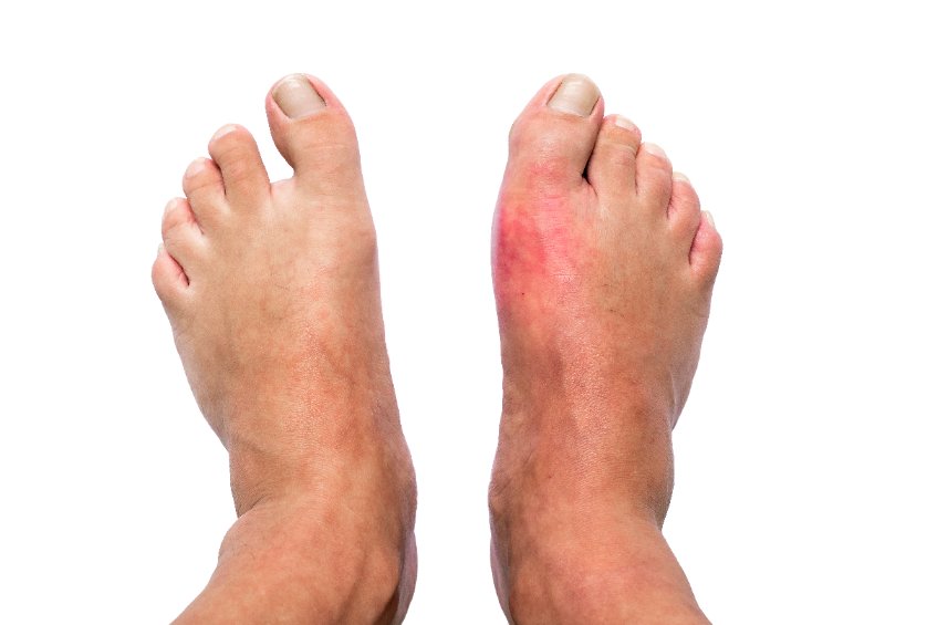 La goutte : causes, diagnostic et traitements 131801667 S