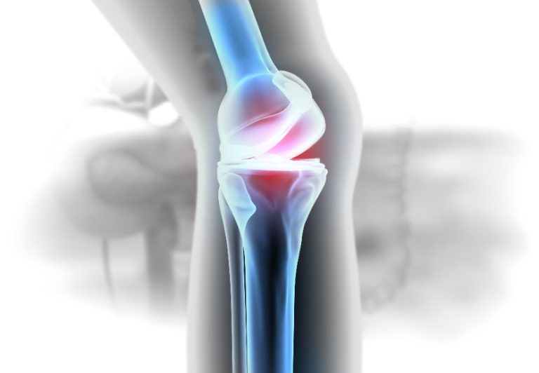 Chondrocalcinose articulaire : causes, symptômes, diagnostic, traitement
