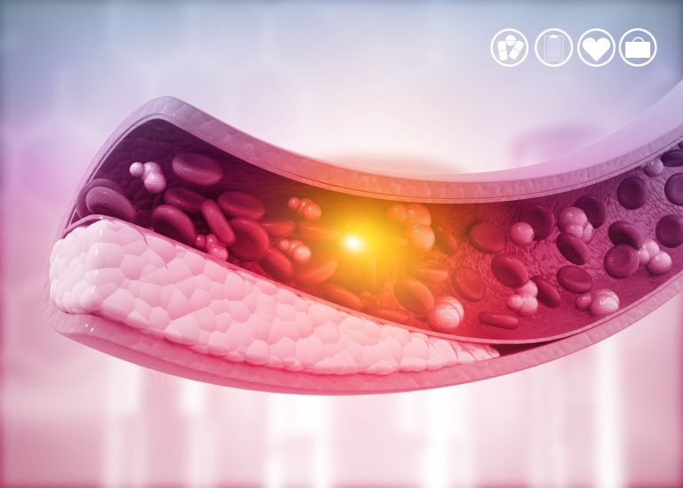 Hypercholestérolémie : causes, symptômes et traitements