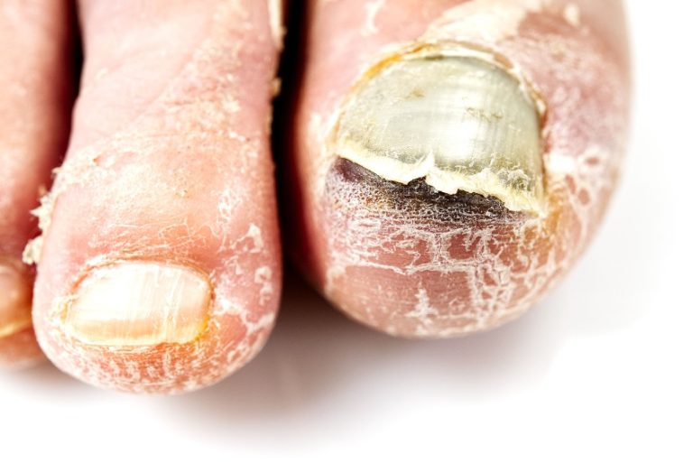 La maladie de Buerger : causes, symptômes, traitement 