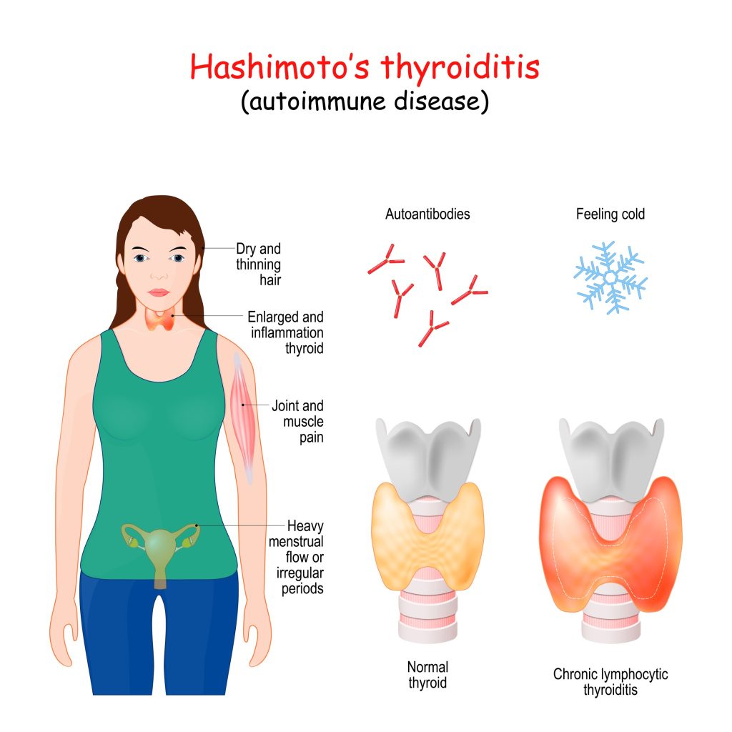 THYROÏDITE DE HASHIMOTO : causes, symptômes et traitements