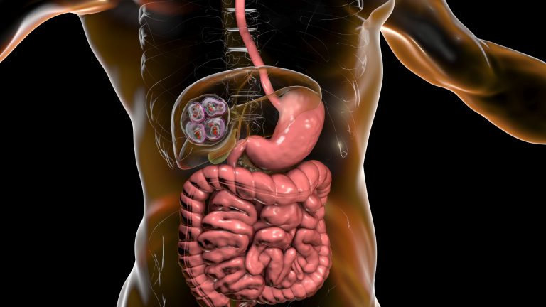 Hydatidose : symptômes, diagnostic et traitements