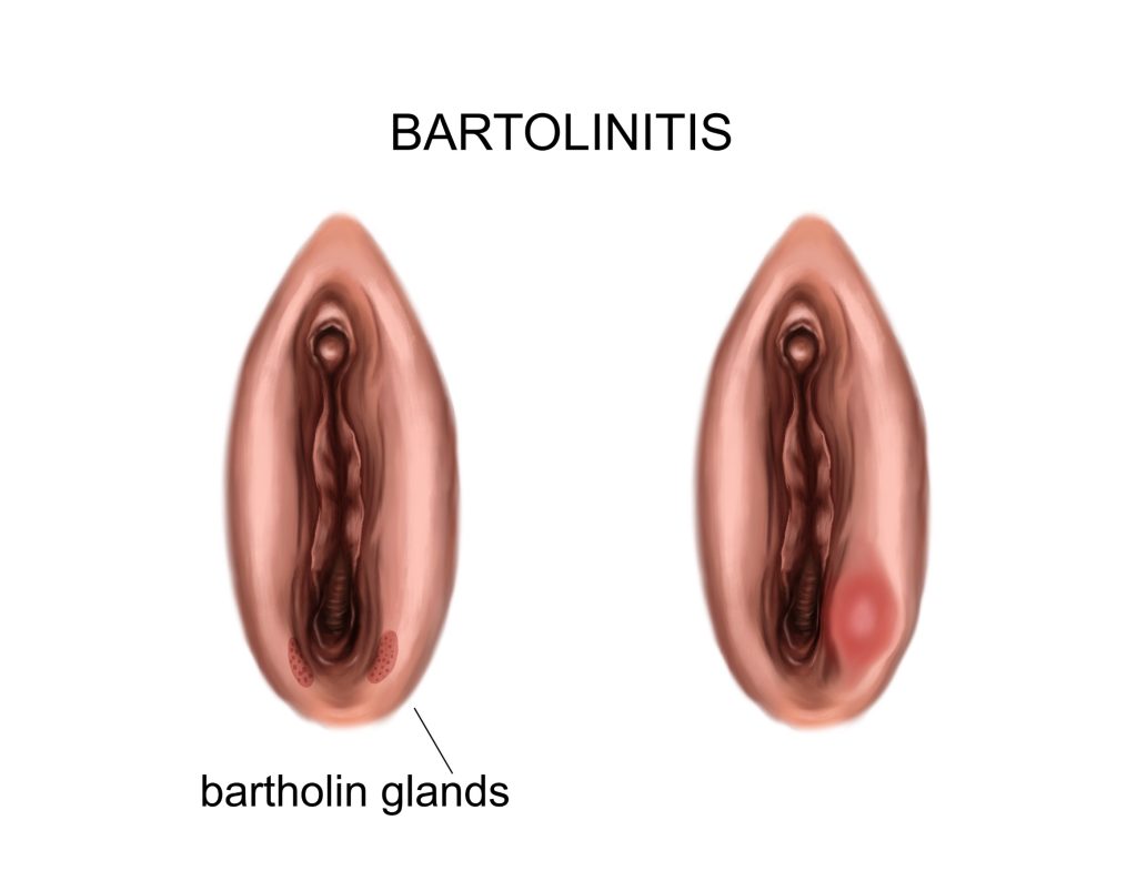 La bartholinite: causes, symptômes et traitements