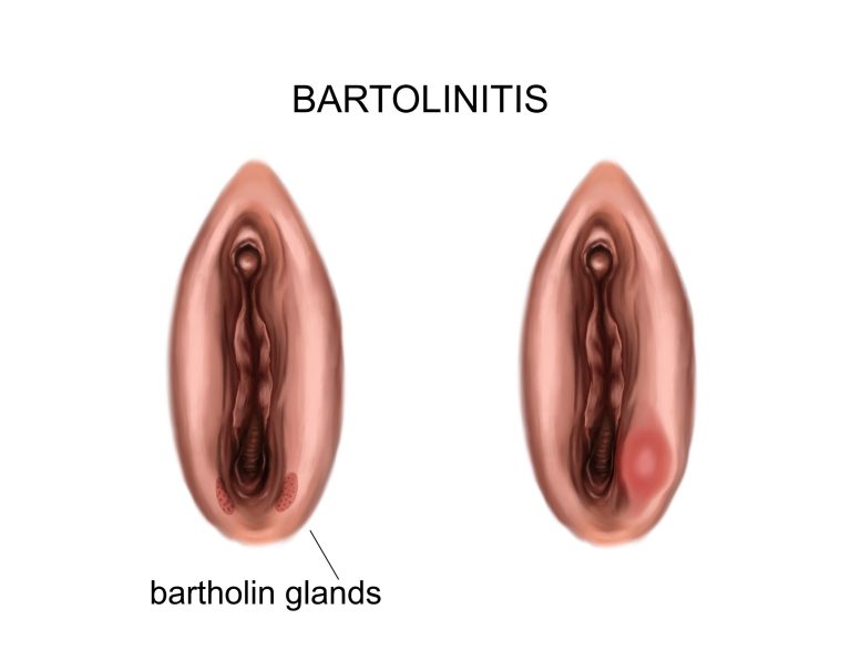 La bartholinite: causes, symptômes et traitements