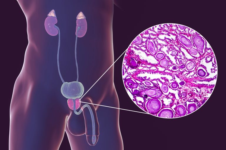 Hypertrophie bénigne de la prostate : causes, symptômes et traitements