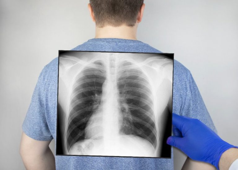 Les dilatations de bronches : symptômes, causes et complications