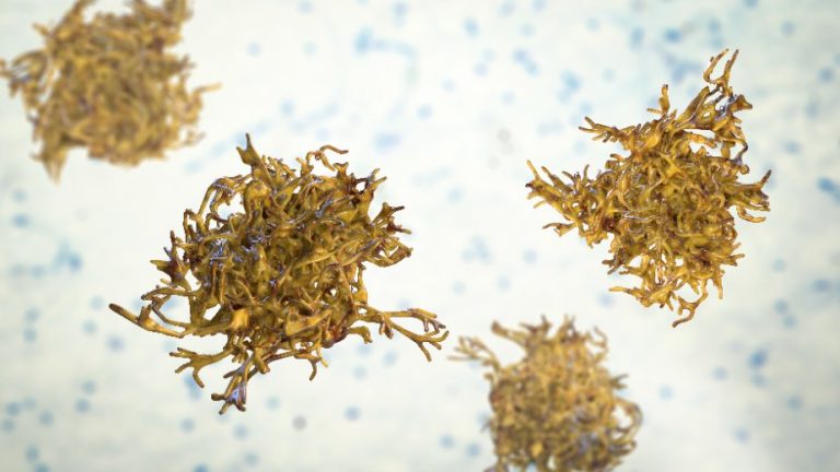 AMIBIASE HÉPATIQUE : Causes, Symptômes, Diagnostic, Traitement