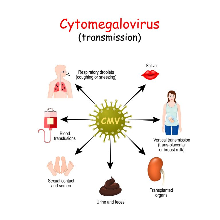 Cytomégalovirus : causes, symptômes et moyens de prévention