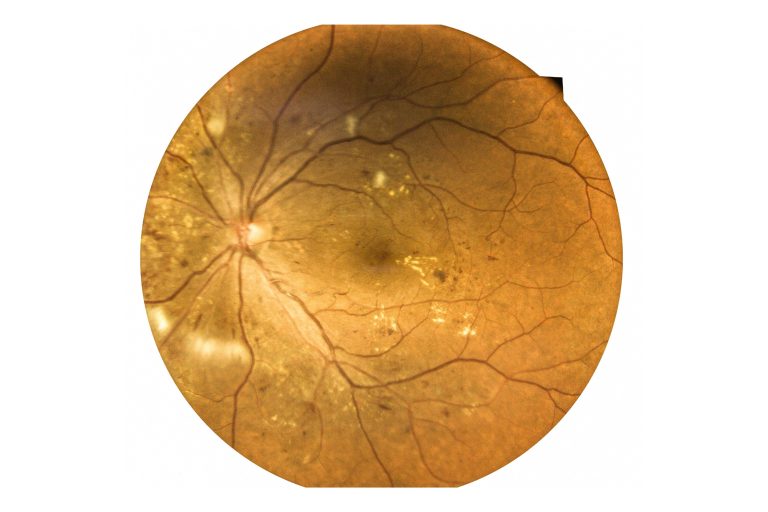 Le décollement du vitré: causes et traitements
