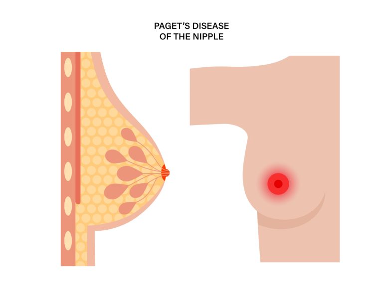 Le cancer du mamelon ou la maladie de Paget: symptômes et traitements