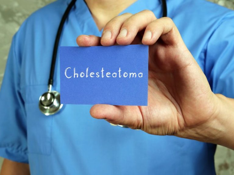 Cholestéatome : Causes, symptômes, diagnostic et traitements