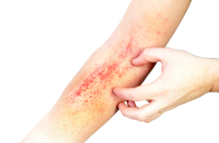 Eczéma de contact : tests cutanés dans le diagnostic
