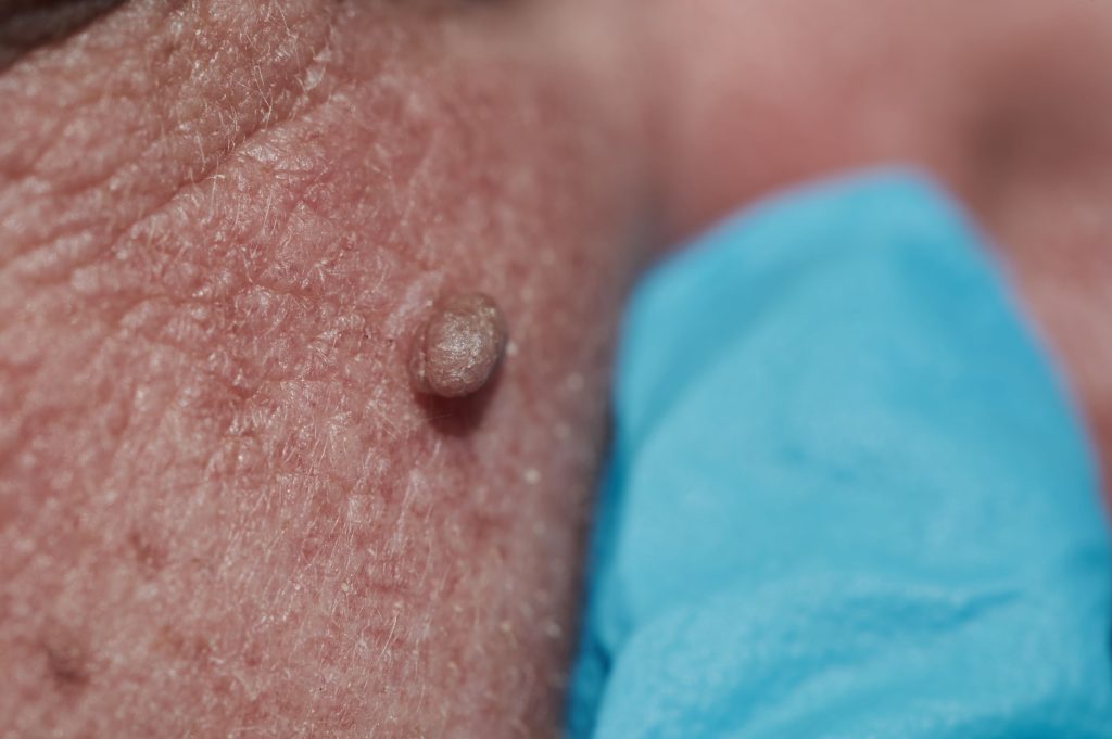 Infection bénigne à virus du papillome humain: causes et traitements