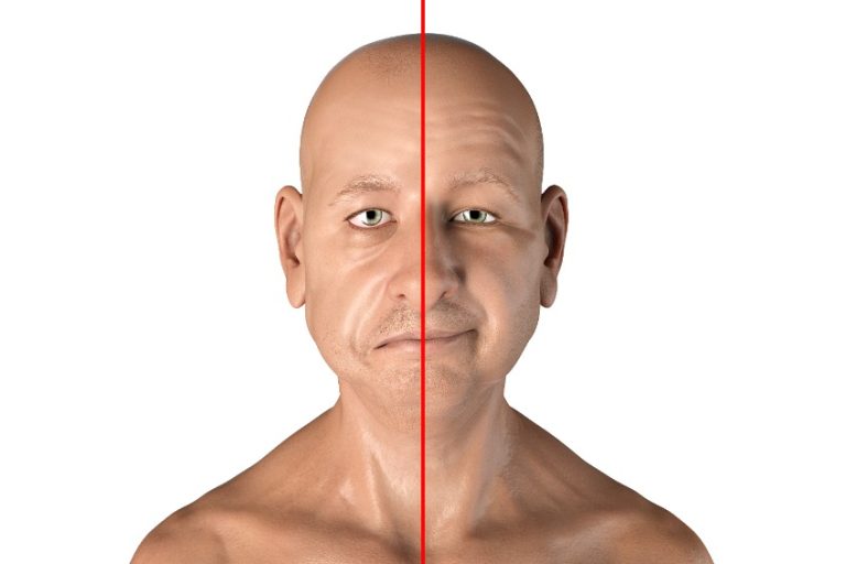 Paralysie faciale a frigore : causes, symptômes, diagnostic et traitement