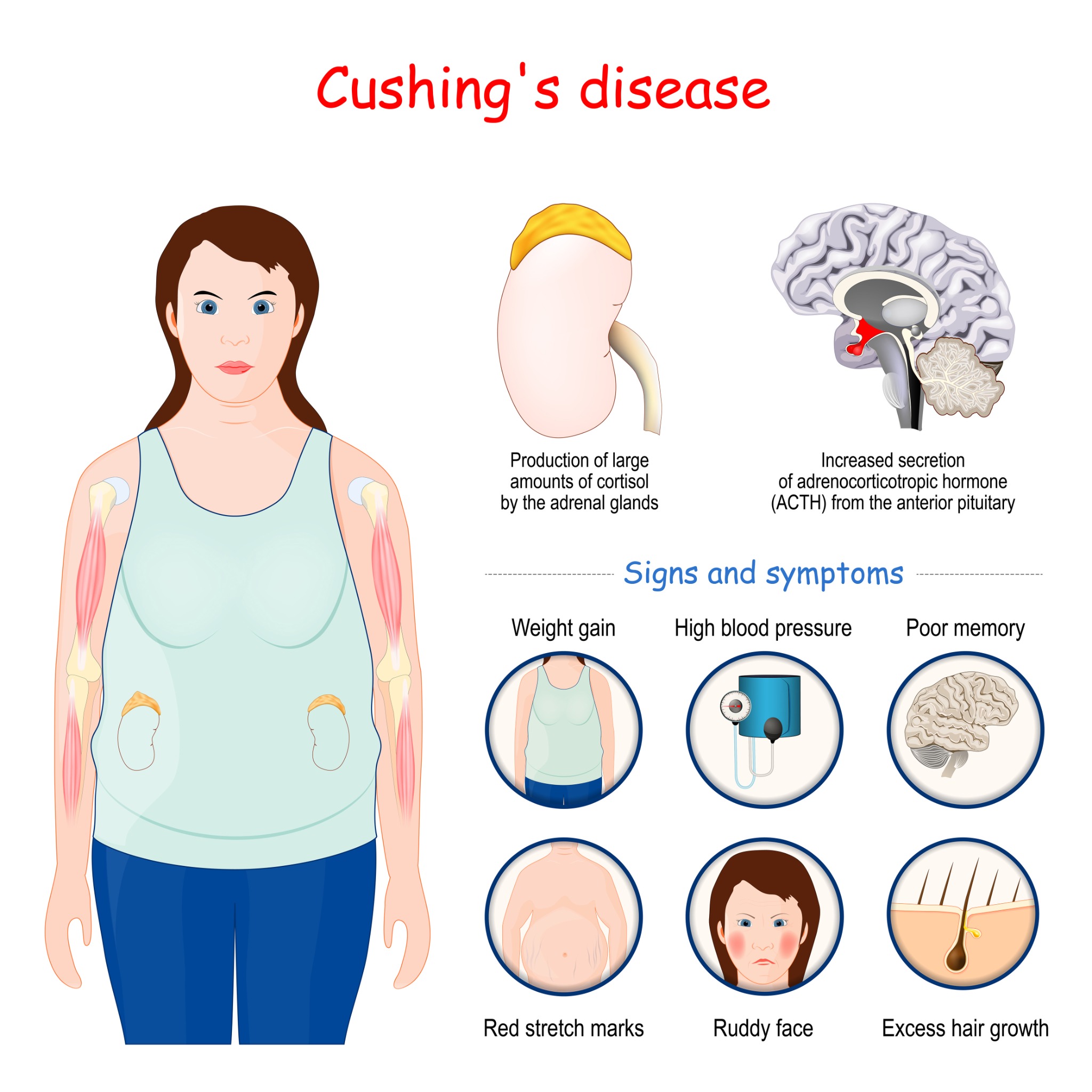Quels sont les causes et traitements du syndrome de Cushing ...