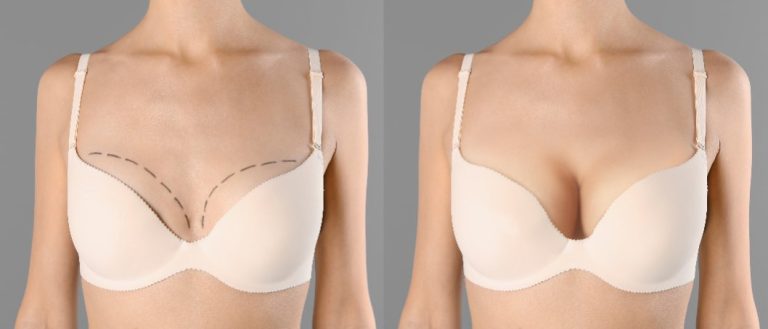 Sein et silicone : utilisation, risques d’allergie et recommandations