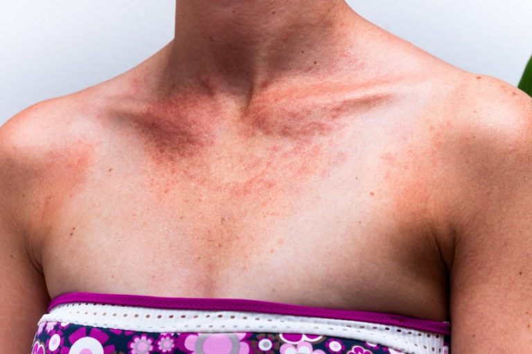 Photodermatoses : différentes formes