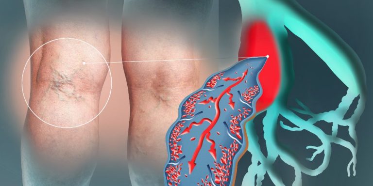 THROMBOSE VEINEUSE PROFONDE : Diagnostic par dosage des D-DIMERES