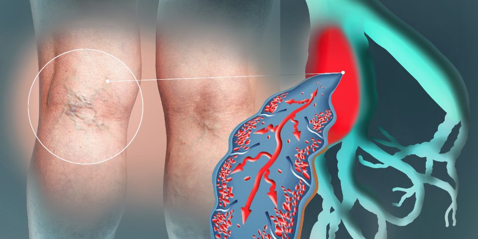THROMBOSE VEINEUSE PROFONDE : Diagnostic par dosage des D-DIMERES