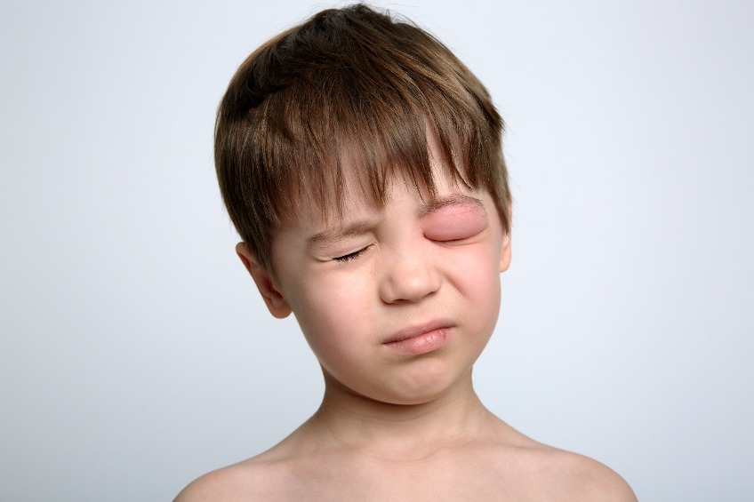 Œdème de Quincke : Causes, Symptômes, Traitement