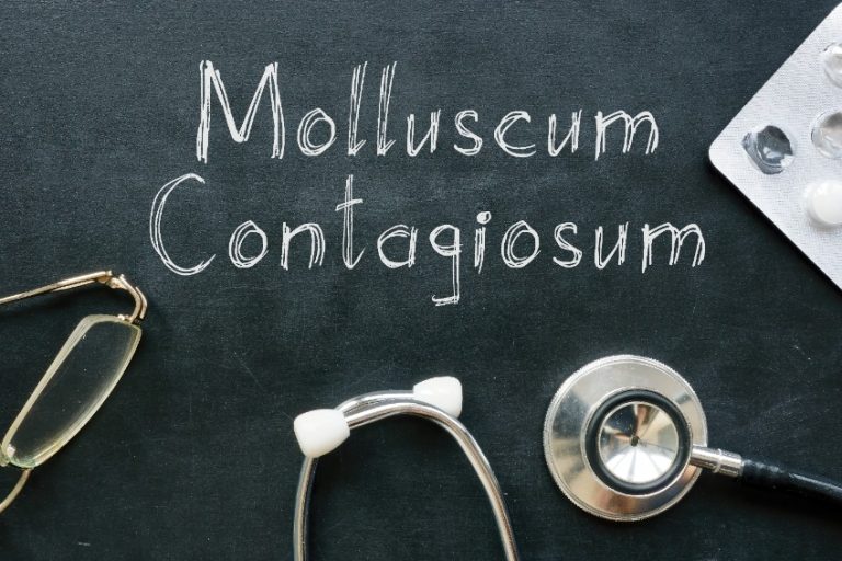 Molluscum contagiosum : agent infectieux, clinique, traitement