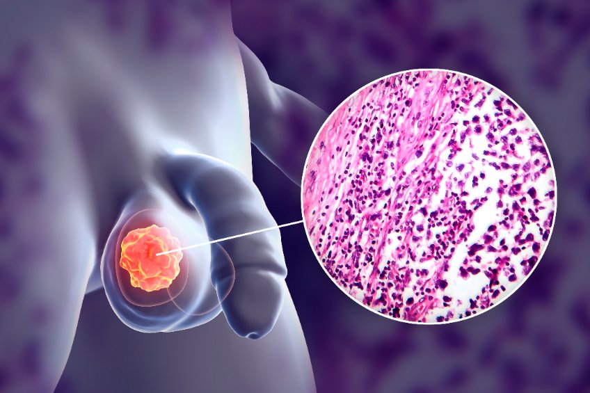 Pathologie des testicules et des bourses : varicocèle, tumeurs ...